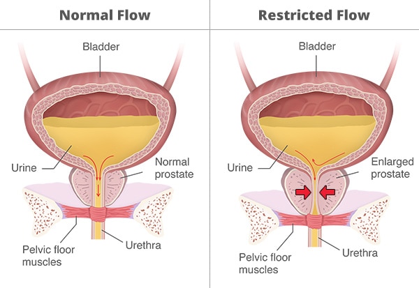 wandering bladder meaning