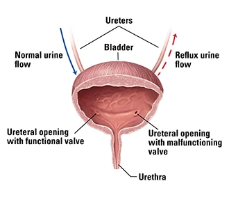 Un'illustrazione della vescica, che comprende l'uretra e due ureteri. Un uretere permette all'urina di fluire normalmente nella vescica; l'altro è danneggiato e rifluisce, rimandando l'urina verso il rene.