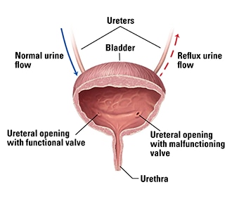 Een afbeelding van een blaas, inclusief de urethra en twee urineleiders. De ene urineleider laat de urine normaal de blaas instromen; de andere is beschadigd en stroomt terug, waardoor de urine terugstroomt naar de nier.