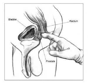 prostate problems prosztata ez az