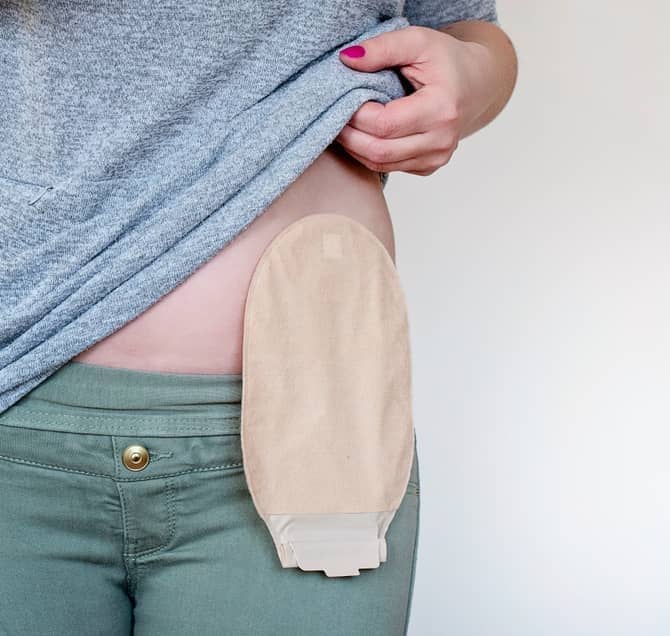 A woman holding up her shirt to show a urostomy pouch attached to her abdomen.