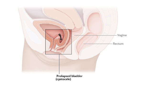 Stages of Uterine Prolapse. Pelvic Floor Muscles Weakening