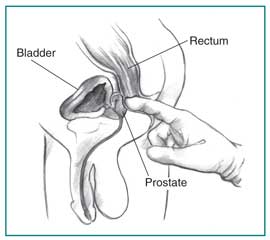 Cross section of a digital rectal exam. A health care provider’s gloved index finger is inserted into the rectum to feel the size and shape of the prostate.