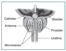 Cross-section of the prostate, bladder, and urethra. A transurethral microwave thermotherapy catheter extends from the urethra into the bladder. An antenna sends microwaves through the catheter to the prostate.