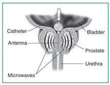 Prečni prerez prostate, mehurja in sečnice.  Transuretralni mikrovalovni termoterapevtski kateter sega iz sečnice v mehur.  Antena pošilja mikrovalove skozi kateter v prostato.