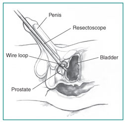 Prečni prerez penisa, prostate in mehurja.  Resektoskop se vstavi skozi sečnico do prostate.  Žična zanka na koncu resektoskopa odreže tkivo prostate.