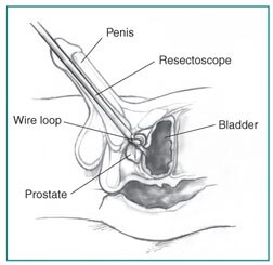 Problems Inserting Penis 55