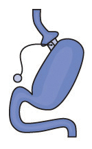Illustration of Gastric Band
