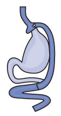 Illustration of Gastric Bypass