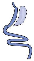 Illustration of Gastric Sleeve