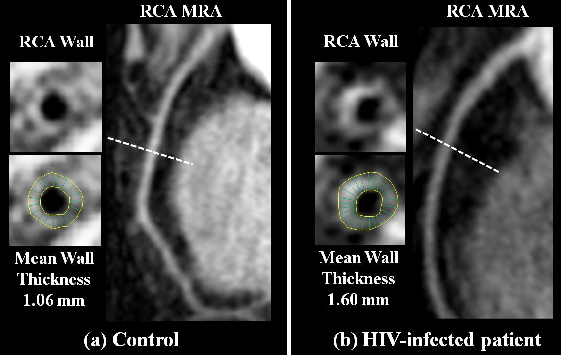 side-by-side pictures of the RCA walls of two different cells