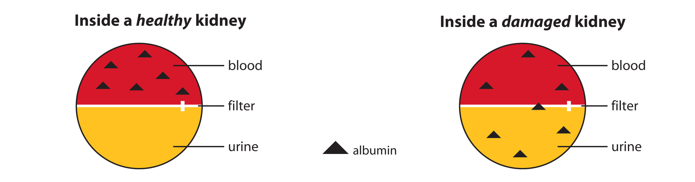 A diagram illustrating a healthy kidney with albumin only found in blood, and a damaged kidney that has albumin in both blood and urine