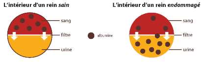 Figure du intérieur d'un rein sain qui illustre comme un rein sain ne permite pas passer l'albuminurie pour l'urine et comme un rein endommagé permite passer l'albuminurie pour l'urine