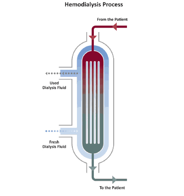 A schematic of the hemodialysis process