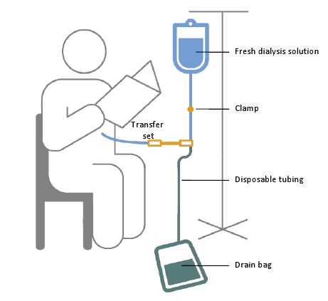 A schematic of a person receiving continuous ambulatory peritoneal dialysis exchange while reading