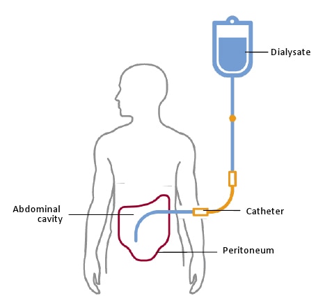 A schematic showing that the peritoneal membrane is the semipermeable “filter” in peritoneal dialysis