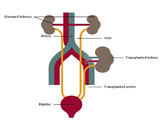 A schematic showing a transplanted kidney placed in the groin area. Native kidneys usually are not removed.