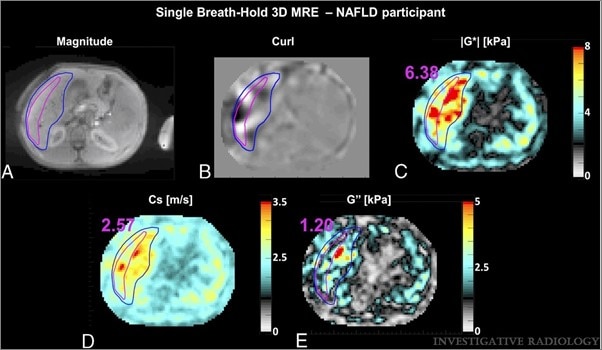 Single Breath-Hold 3-Dimensional Magnetic Resonance Elastography Depicts Liver Fibrosis and Inflammation in Obese Patients