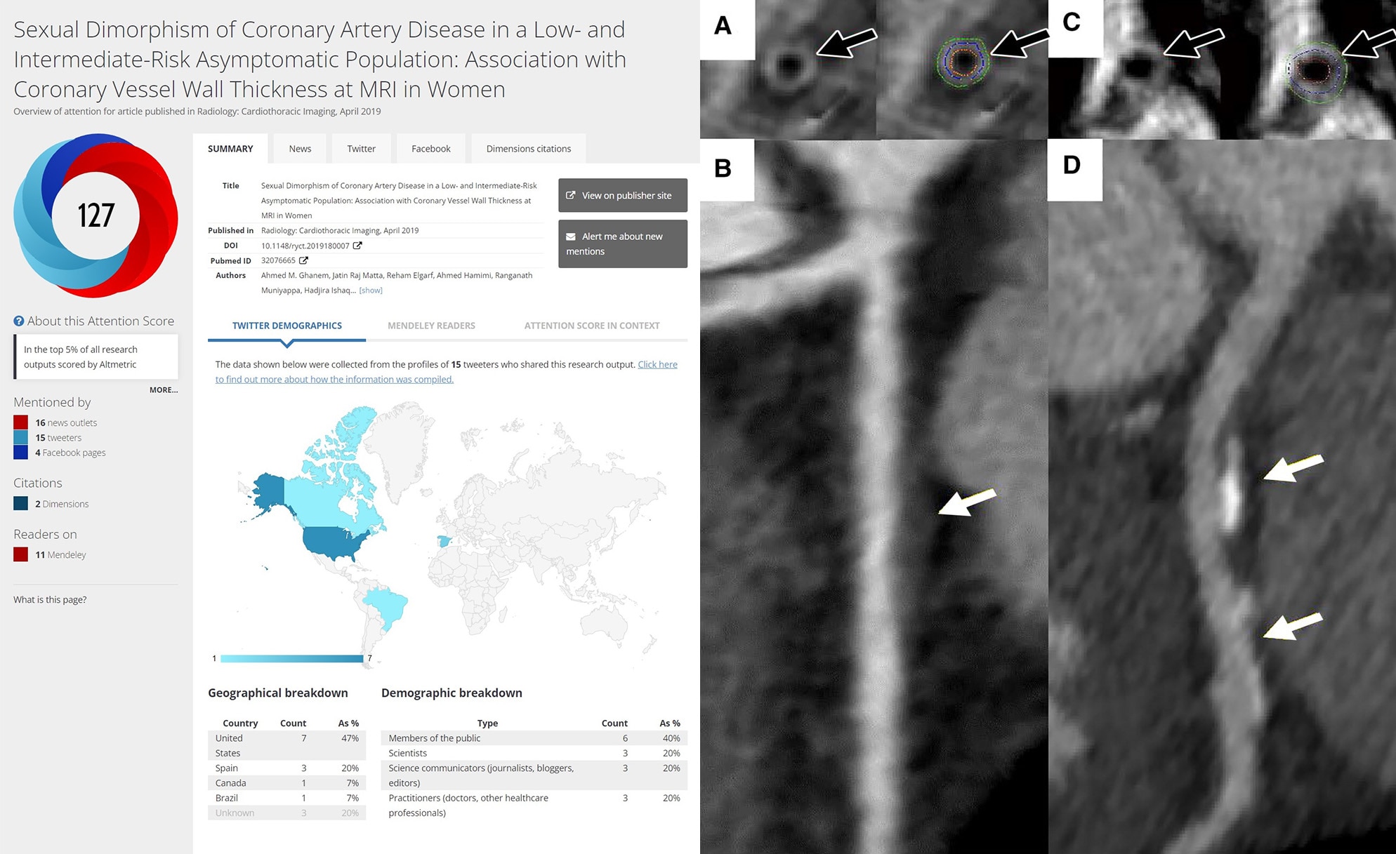 Graphic of sexual dimorphism of coronary artery disease and scans of an asymptomatic woman.