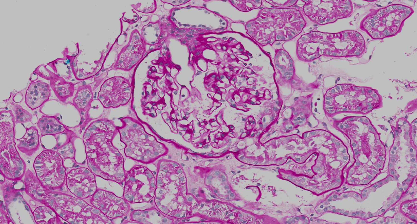 Glomerulus and attached proximal tube (clinical biopsy)