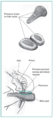 Drawing of two bike seats, with and without a nose. Side-outline view of a person sitting on a bike seat, with pinched perineal nerves and blood vessels labeled.