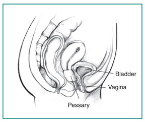 Drawing of a woman’s pelvic area showing the vagina, bladder, and an inserted pessary.
