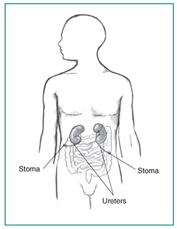 Drawing of a cutaneous ureterostomy. Labels point to two stomas and two ureters.