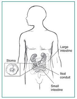 Drawing of an ileal conduit diversion, with stoma enlarged in inset box. Labels point to a stoma, large intestine, ileal conduit, and small intestine.