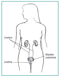 Drawing of a bladder substitute. Labels point to two ureters, bladder substitute, and urethra.