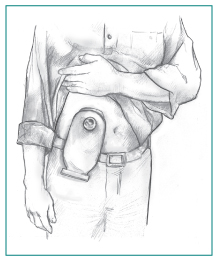 Drawing of a man holding up his shirt to show a urostomy pouch attached to his abdomen.