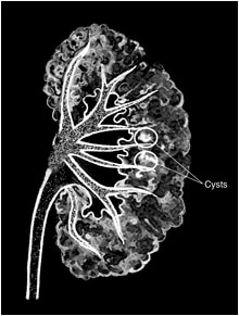 Drawing of a medullary sponge kidney as seen in an intravenous pyelogram. The background is black. The large part of the kidney appears to be porous, like a sponge. Two white spots on the kidney are circled. A label identifies the white spots as cysts.