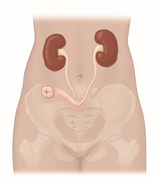 An ileal conduit with stoma shows the ureters attached to a stoma using a segment of intestine.