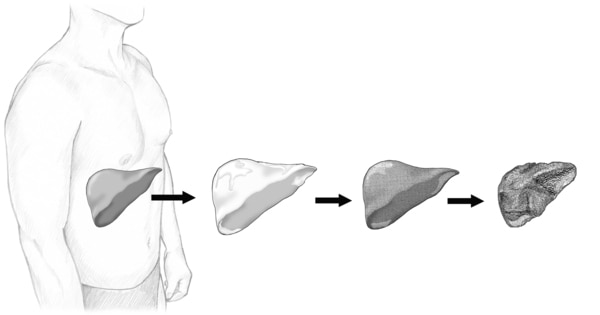 Illustration of the stages of liver damage leading to cirrhosis.