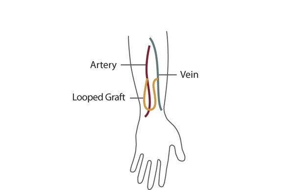 AV graft in a forearm.