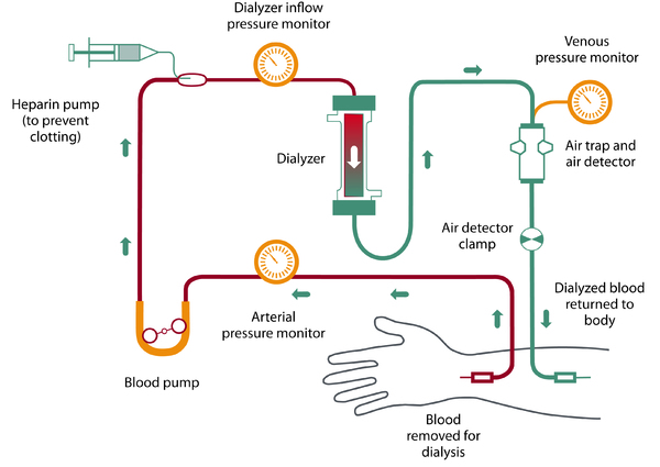 Schematic of hemodialysis.