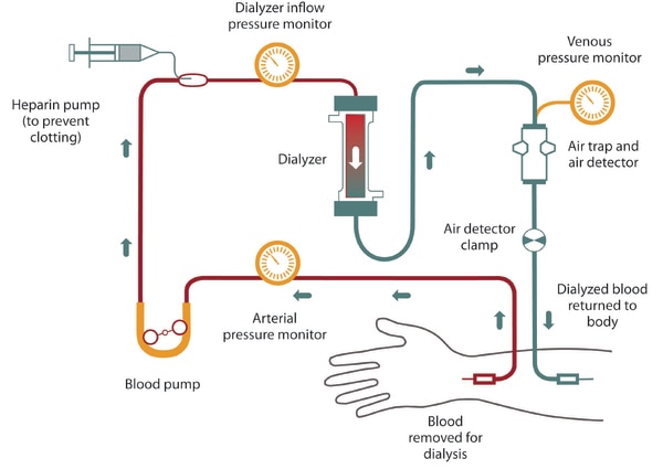 Schematic of hemodialysis.