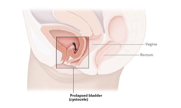 Illustration of a cross-section view of the female pelvis from the side, showing the bladder dropping into the vaginal wall. The vagina, rectum, and prolapsed bladder (cystocele) are labeled.