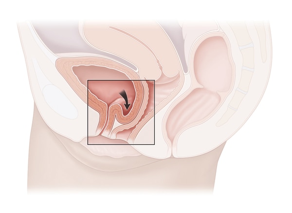 Illustration of a cross-section view of the female pelvis from the side, showing the bladder dropping into the vaginal wall. 