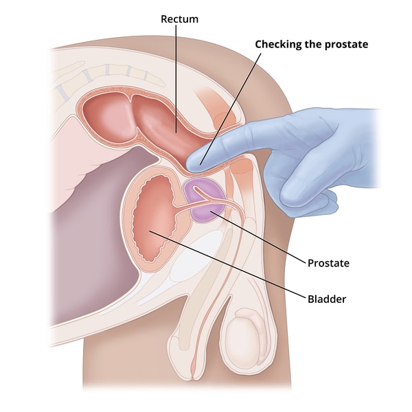 A cross-section diagram of a digital rectal exam. The rectum, prostate, and bladder are labeled.
