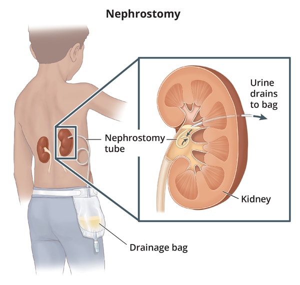 A nephrostomy tube inserted into the kidney through the patient’s back and connected to an external drainage pouch.