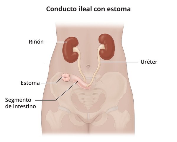 Un conducto ileal, con una imagen inserta que muestra un primer plano de un estoma.