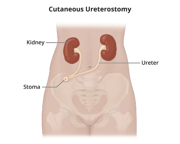 Cutaneous Ureterostomy - Labeled - Media Asset - NIDDK