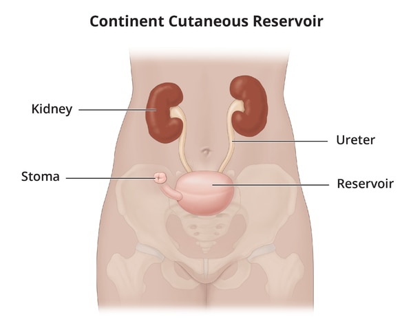 A continent cutaneous reservoir attaches the ureters to a internal pouch, which empties through a stoma.