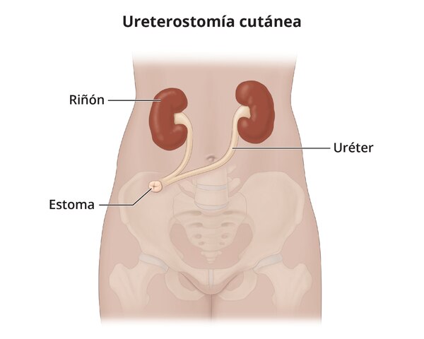 Una ureterostomía cutánea con ambos uréteres unidos a un estoma.