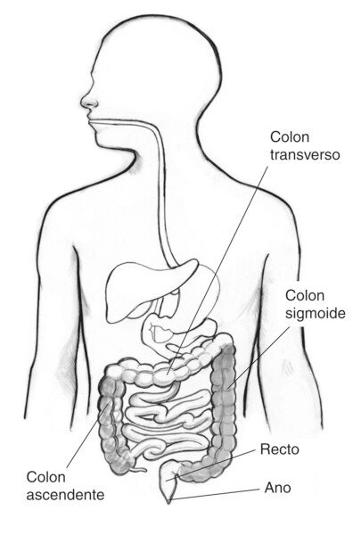 Dibujo del tracto digestivo en el que se señala el colon ascendente, colon transverso, colon sigmoide, recto y ano. Elcolon ascendente y el colon sigmoide están sombreados.