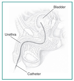 Catheter placed into a male urethra and bladder.
