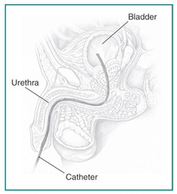 Catheter placed into a male urethra and bladder.