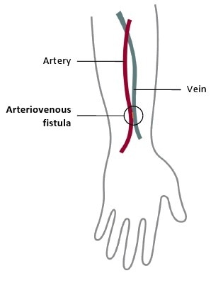 Illustration of an arteriovenous fistula for hemodialysis in the outline of a forearm. The artery, vein, and fistula are labeled.