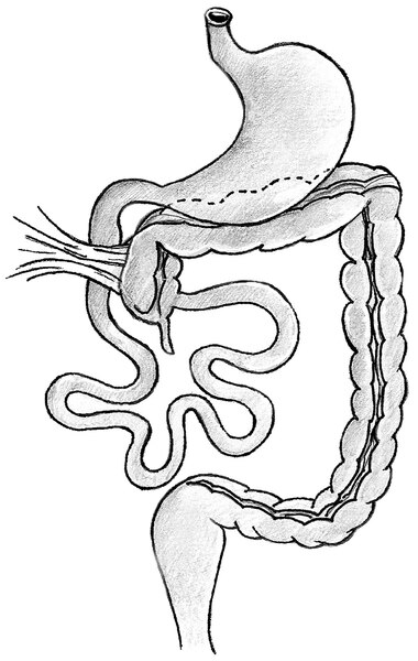 Illustration of malrotation of the bowel in which the cecum is not positioned correctly.