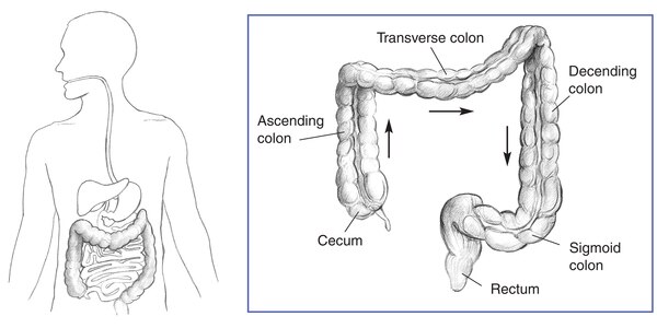 Illustration of the lower gastrointestinal tract inside the outline of a man’s torso. Inset of the lower gastrointestinal tract with the cecum, ascending colon, transverse colon, descending colon, sigmoid colon, and rectum labeled.